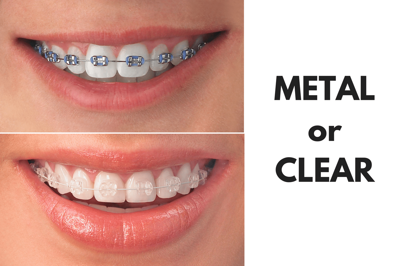 Ask Your Carrollton Dentist: Should I Get Metal or Clear Braces?